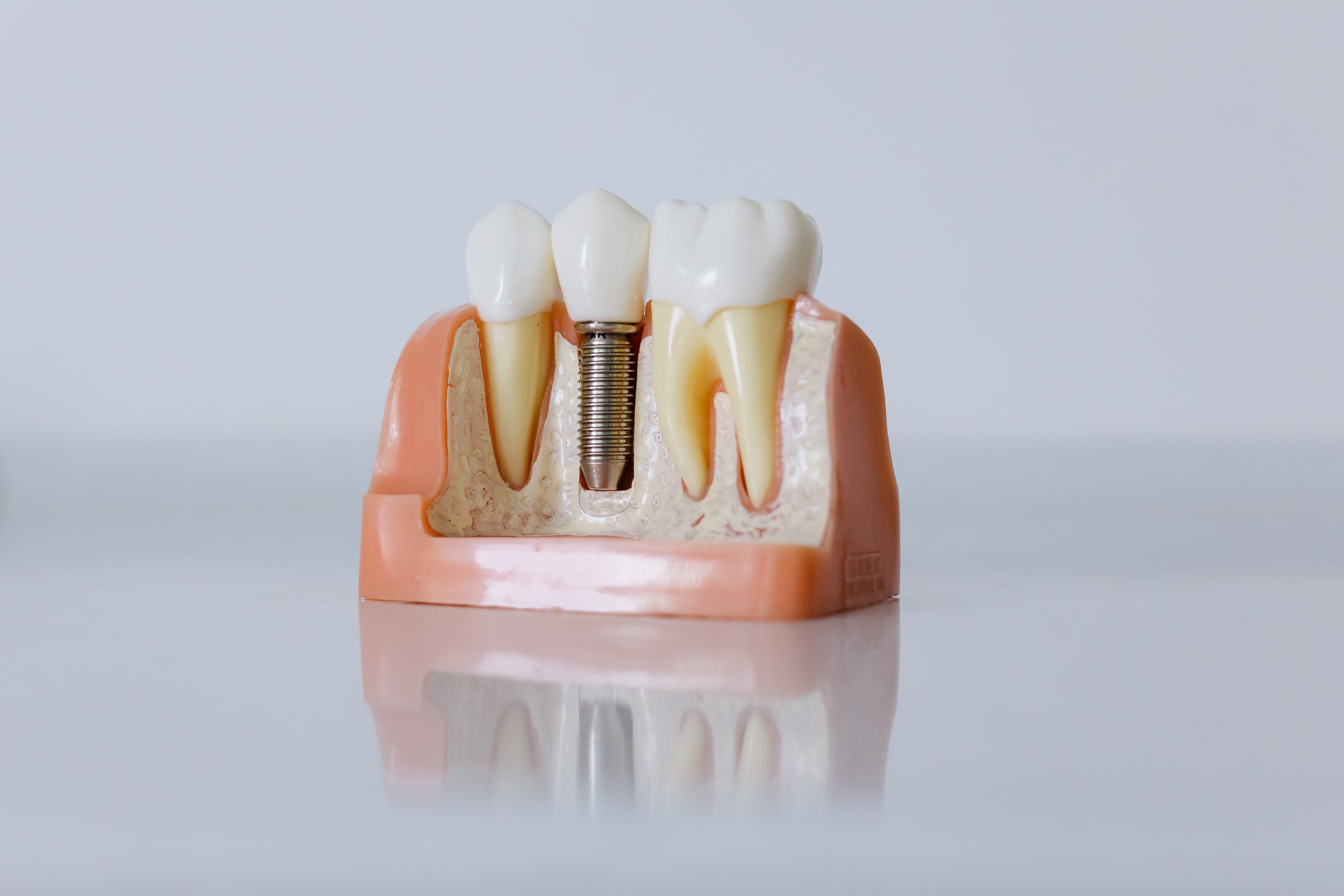 Pose d'implants et réhabilitation implantaire