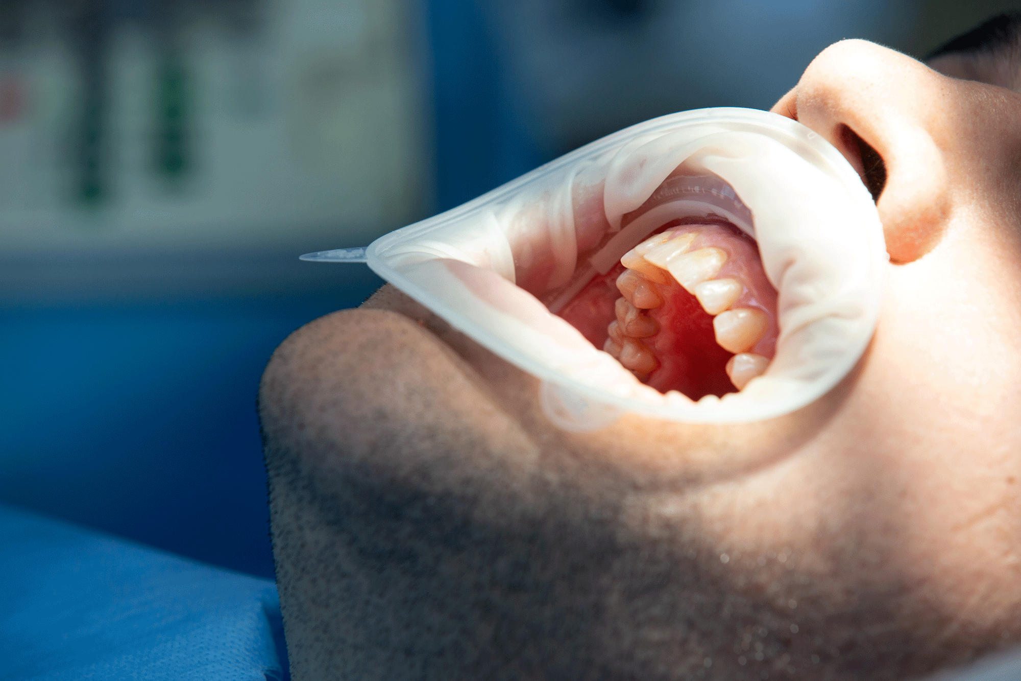 Extraction des dents de sagesse