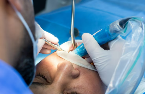 Chirurgie parodontale