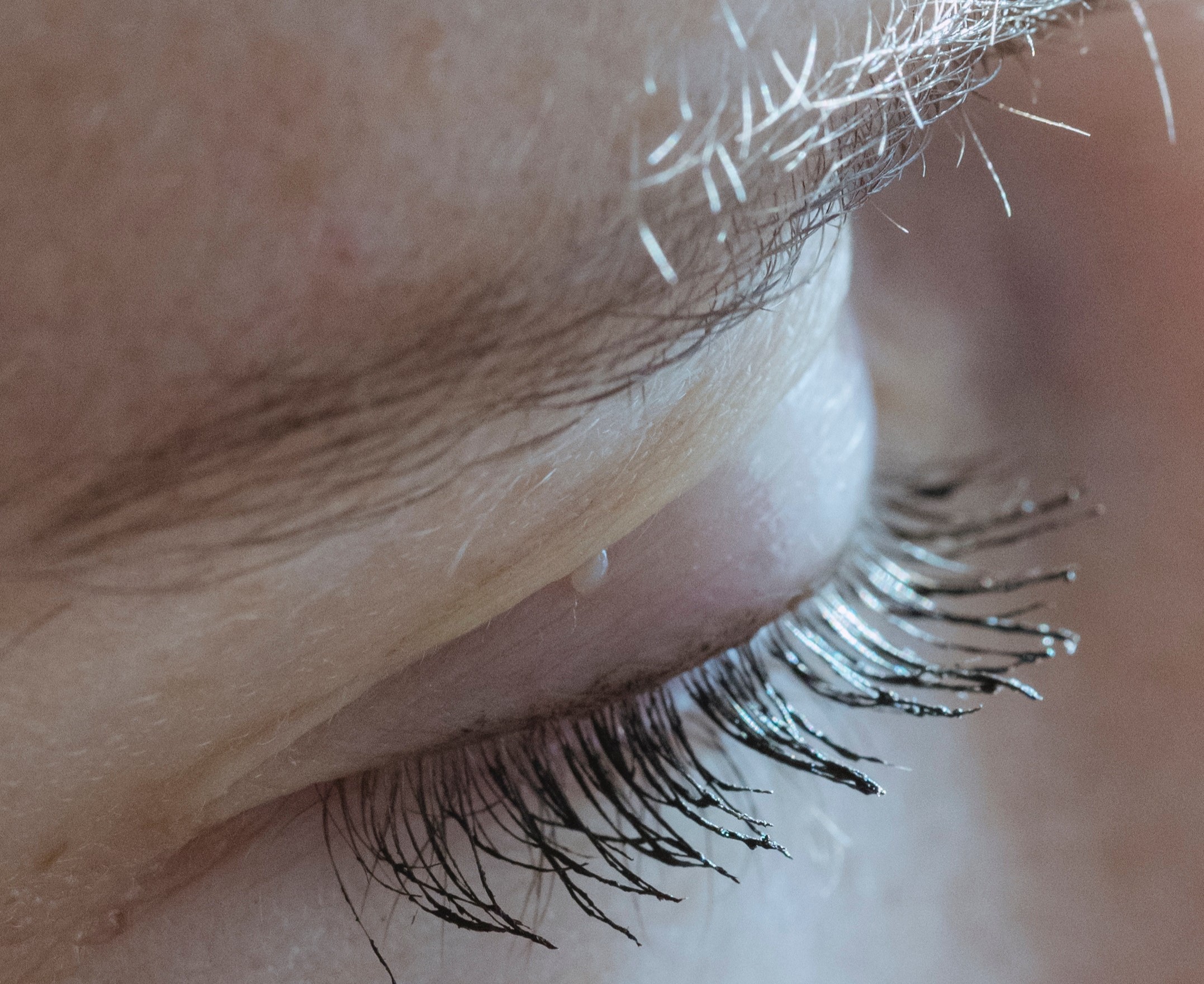 Chirurgie des paupières