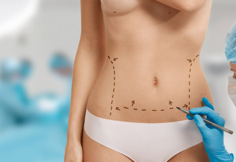 Chirurgie de la silhouette