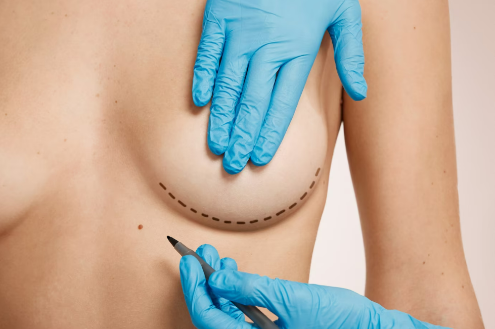 Chirurgie des seins, pectoraux