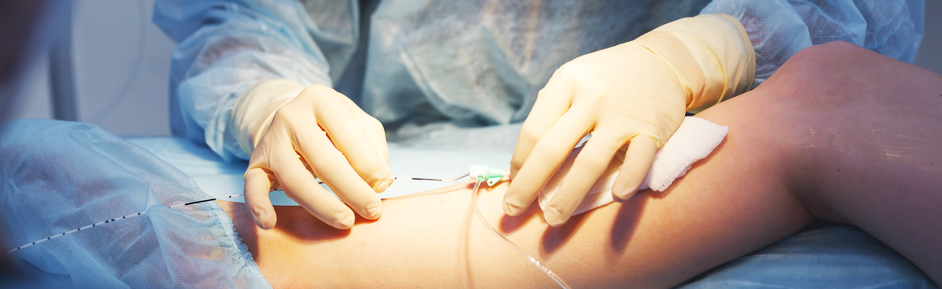 Ablation endoveineuse