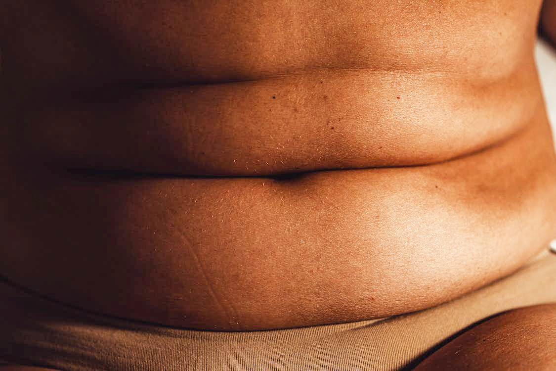 Chirurgie post-bariatrique et body lift